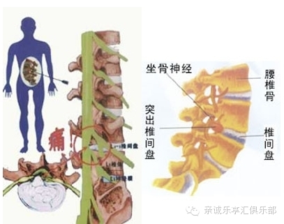 腰间盘突出不是病,千万别给医生切啦 !