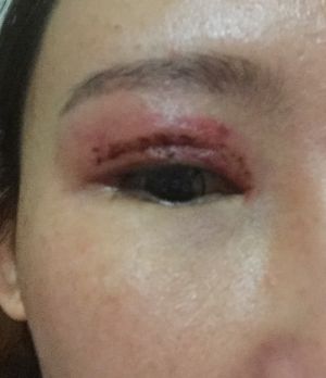 无证整形庸医瞄准华人群体 华女轻信受害 恐永久毁容